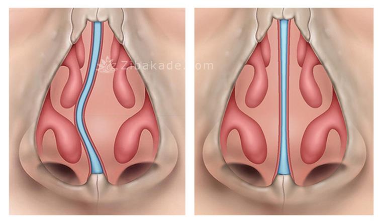 انحراف بینی 